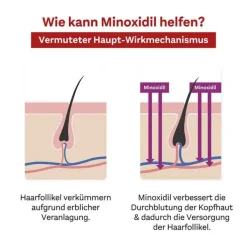MINOXIDIL DoppelherzPharma 20 mg/ml Lösung für Frauen, 3X60 ml