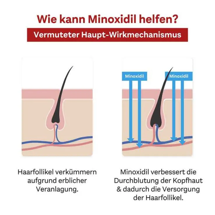 MINOXIDIL DoppelherzPharma 50 mg/ml Lösung für Männer, 3X60 ml